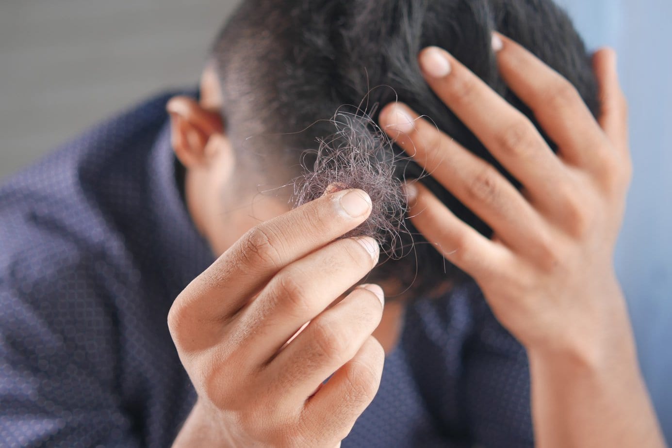 Alopecia areata – what is this condition?